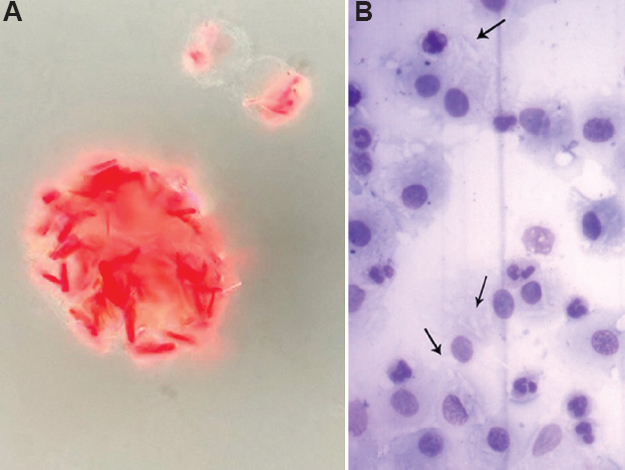 (A) Alveolar macrophages loaded with birefringent, bright red and needle-shaped crystals characteristic of clofazimine (polarized unstained wet preparation, ×1000). (B) Faint linear spaces in alveolar macrophages were the only possible clues in stained cytosmears (arrows) (Leishman stain, ×100).